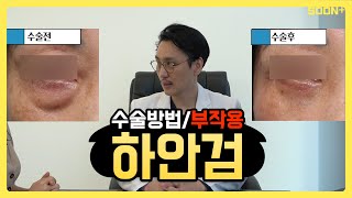 하안검 수술 과정부터 부작용까지 한 번에ㅣ추천 대상ㅣ순플러스성형외과 - Youtube