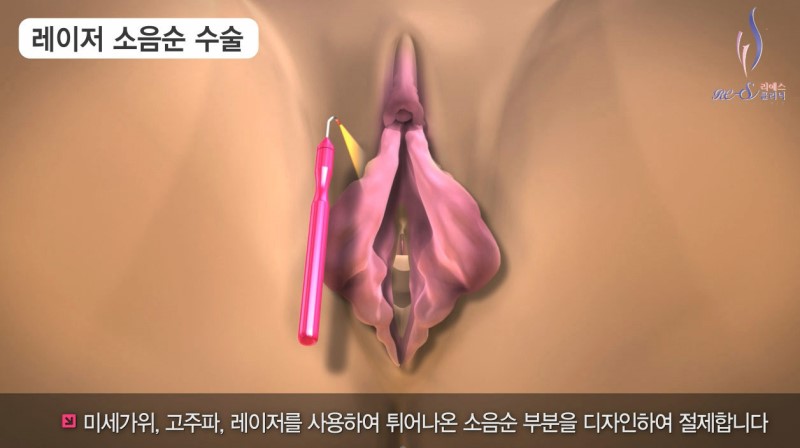 소음순수술후기 세번 놀라는 이유 : 네이버 블로그