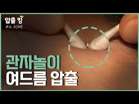 [압출킹] 12. 속이 시원해지는 관자놀이 여드름 압출 ASMR 🤑시원함 주의!!!🤑