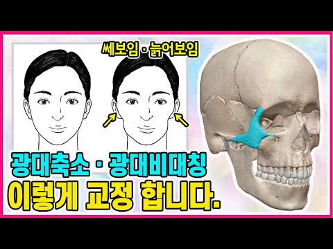 광대축소, 광대비대칭 리샘순수본 안면비대칭교정 원리 알아보기 / 얼굴비대칭교정 / 얼굴비대칭, 안면비대칭[교정의 신, 리샘TV]