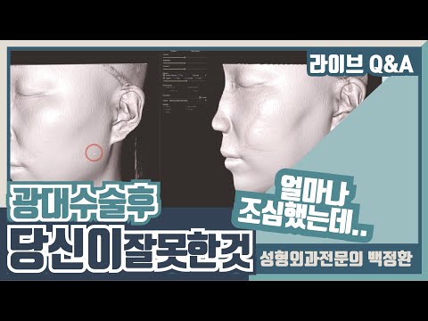 볼처짐, 불유합, 과교정은 여러분들이 만드는 거예요..광대수술후 잘못된 지식