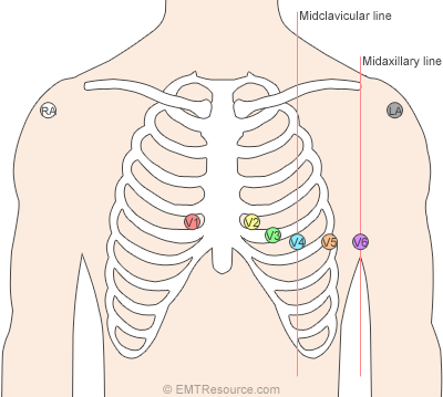 Ecg Lead Placement: Cheat Sheet | Dailyem