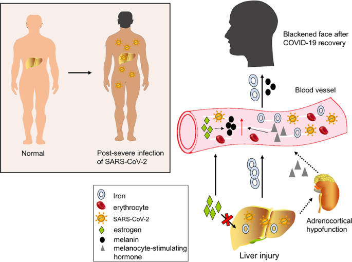 Covid-19-Associated Gastrointestinal And Liver Injury: Clinical Features  And Potential Mechanisms | Signal Transduction And Targeted Therapy