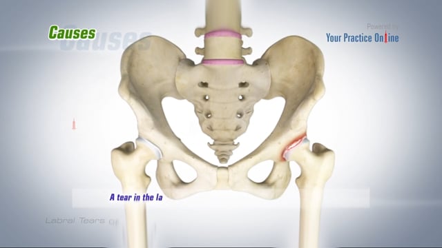 Hip Labral Tear Treatment West Midlands | Traumatic Injury Birmingham