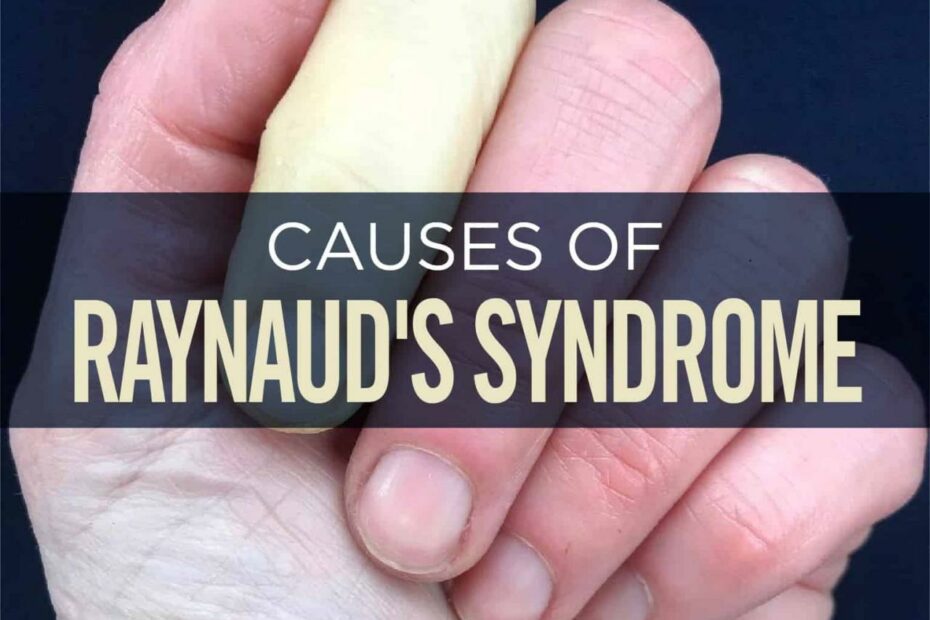 Raynaud'S Syndrome: Symptoms, Causes & Treatment