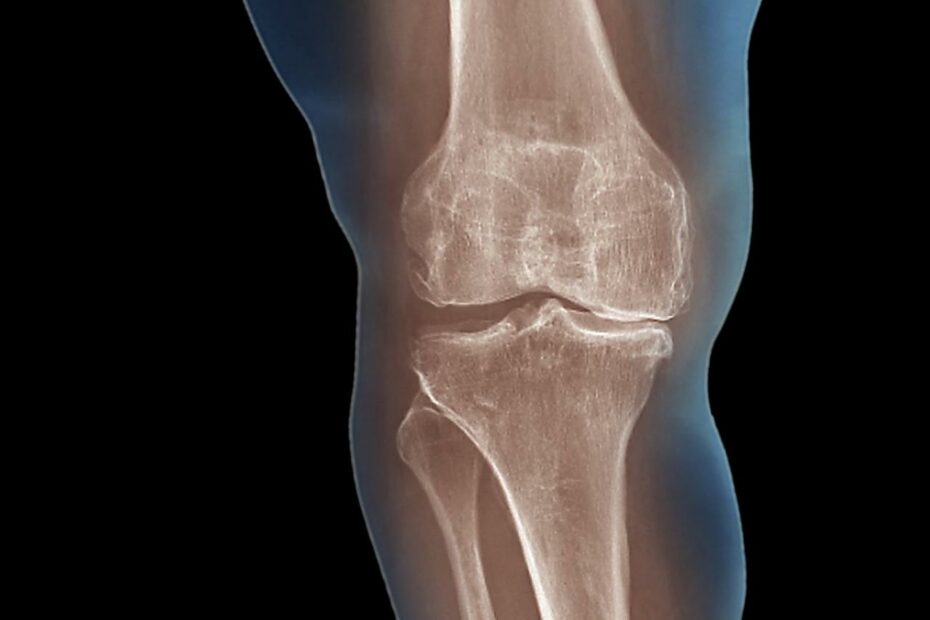 Osteoarthritis (Degenerative Arthritis): Symptoms And Treatment