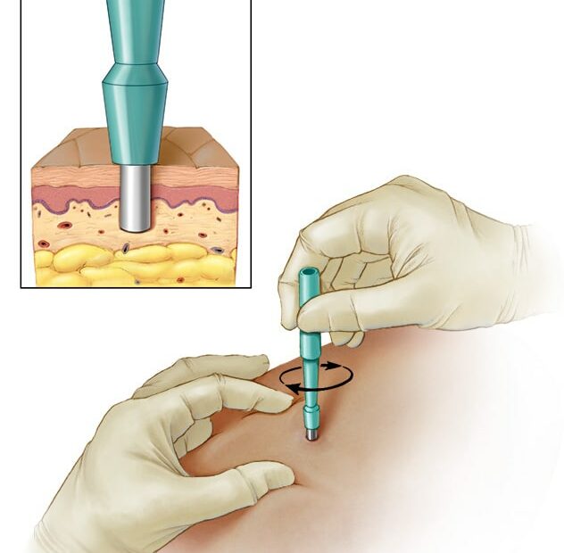 Skin Biopsy - Mayo Clinic