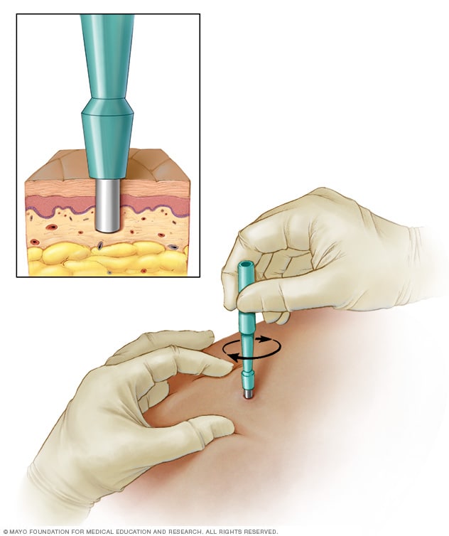 Skin Biopsy - Mayo Clinic