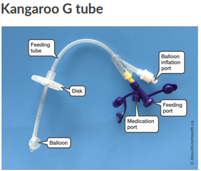 Hint: How Do I Check To See If A G-Tube Balloon Is Broken Or Blocked? —  Connected Care @ Sickkids