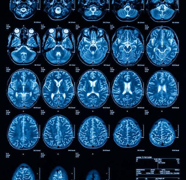 Blindsight: A Strange Neurological Condition That Could Help Explain  Consciousness