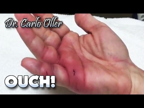 Infected Dog Bite To The Hand - Youtube