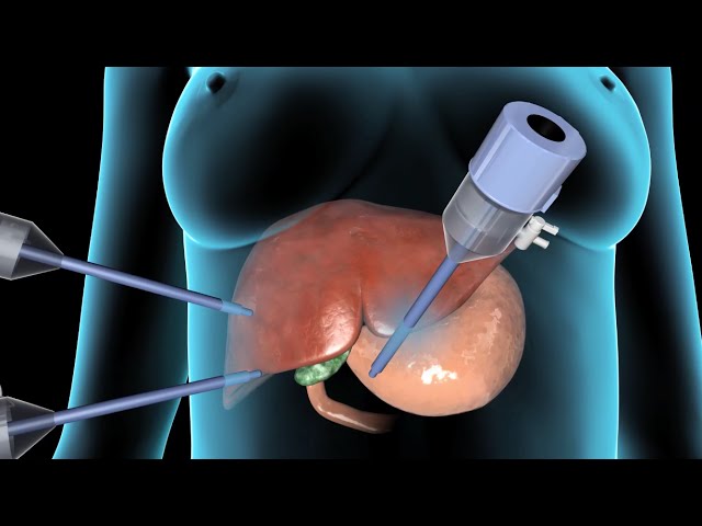 Cholecystectomy | Gallbladder Removal Surgery | Nucleus Health - Youtube