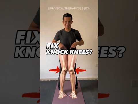 Effective way to fix KNOCK KNEES! #knockknees #kneepain #knee #kneearthritis #kneepainrelief #short