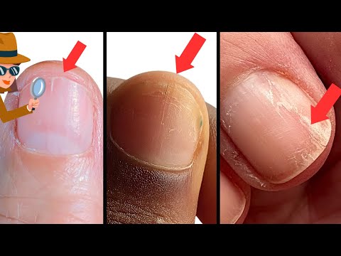 How to Survive Splitting Nails. Causes & Remedies.