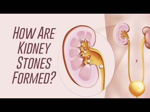 How Kidney Stones are Formed?