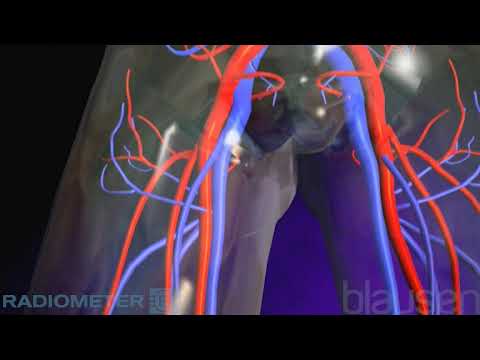 Pulmonary Embolism