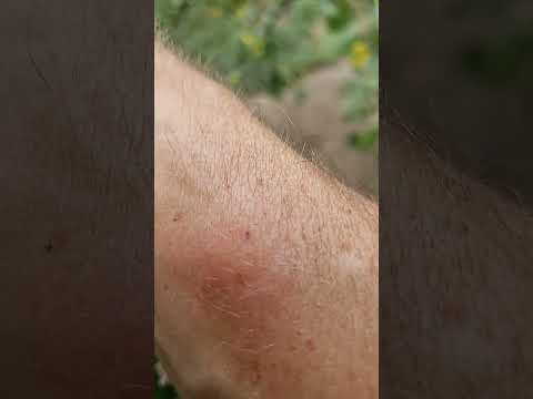 What Does a Bumble Bee Sting Look Like