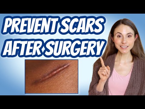 HOW TO PREVENT SCARS AFTER SURGERY 💉 DERMATOLOGIST @DrDrayzday