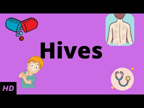 HIVES, Causes, Signs and Symptoms, Diagnosis and Treatment.